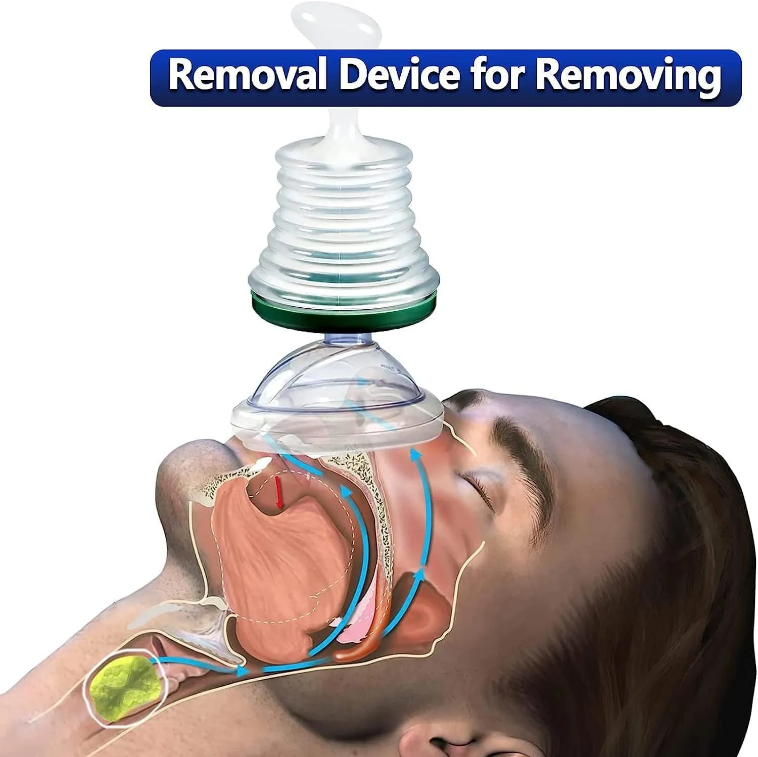 NEW Choking Rescue Device for Adults and Kids, Portable First Aid Choking Device, Choking Emergency Device Training Model, Anti Choking Device for Indoor and Outdoor